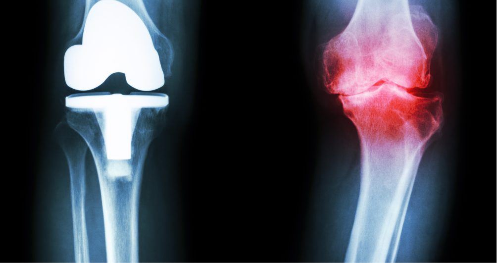 arthrose-douleur-pour-hanche-genou