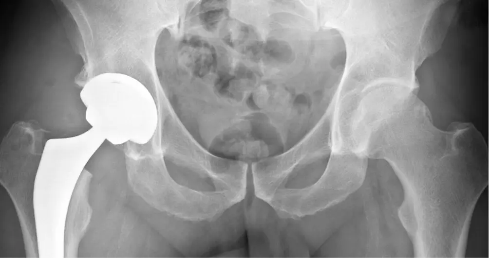 arthrose-douleurs-pour-hanche-genou